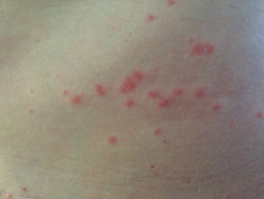 Understanding Sea Lice: Symptoms and Relief with Jelly-Smack Sting Relief