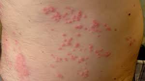 Understanding Sea Lice and Why Jelly-Smack is Your Beach Buddy